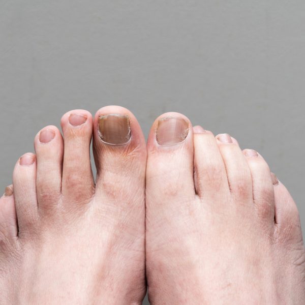 Male Feet onychomycosis with fungal nail infection